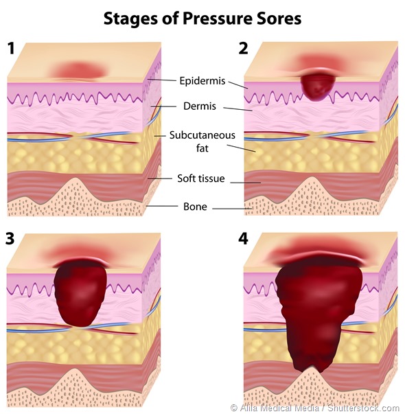 Stages of pressure sores