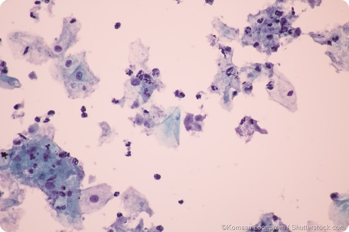 Trichomonas in pap smear microscopic