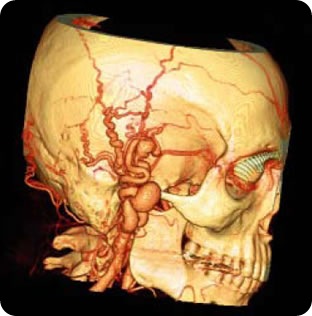 Cranial malformation: 3D targeted volume reformat