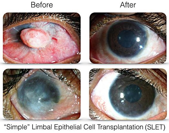 SLET Simple Limbal Epithelial Transplantation