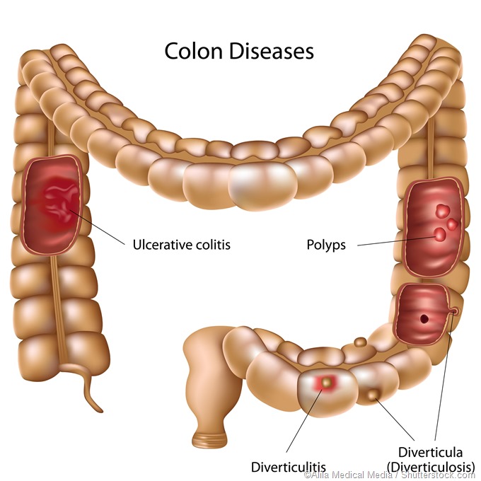 colon diseases illustration