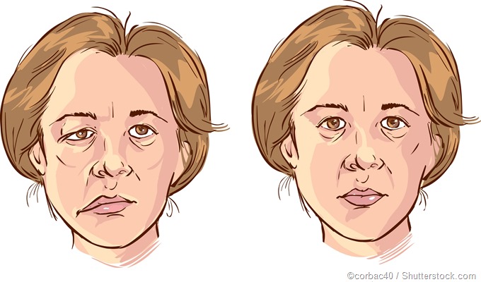 facial palsy illustration