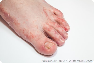 foot dermatitis