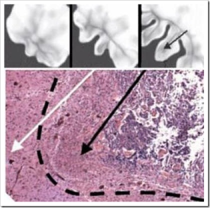 These computer-generated depictions of a growing brain tumor show growth at six, eight and 12 months (top, left to right), with development of infiltrative cell front (arrow) at 12 months. Tissue slide (bottom) shows tumor finger (black arrow) advancing in substrate gradient (white arrow).