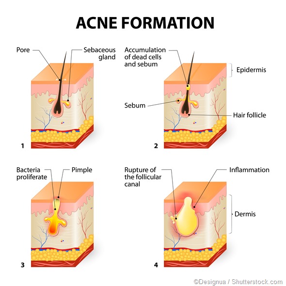 illustration of acne formation in skin