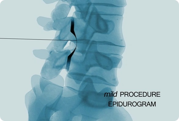 mild Pre Procedure Imaging