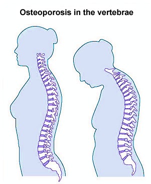 Osteoporosis in the vertebrae