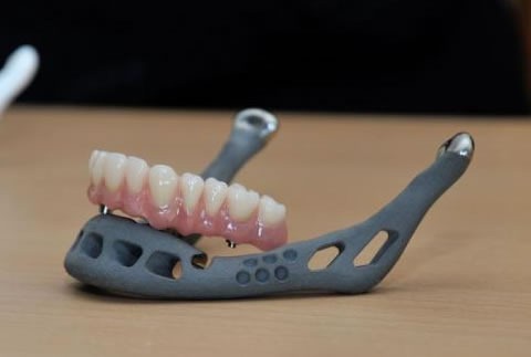World's first 3D printed jaw transplant