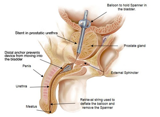 The Spanner™ temporary prostatic stent