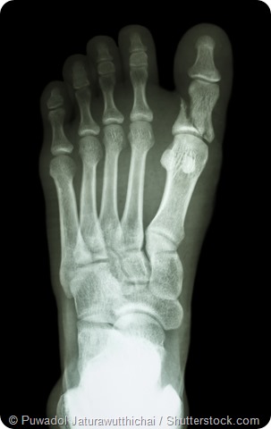 Fractured foot x-ray