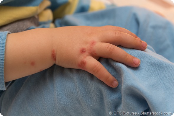 baby hand eczema