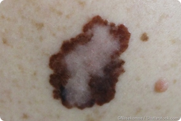 skin melanoma