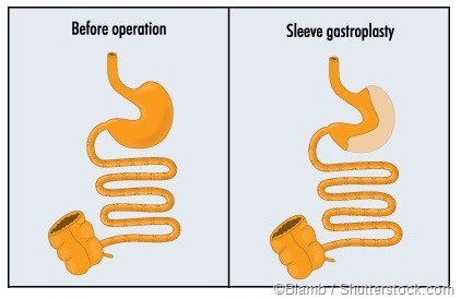 sleeve gastroplast
