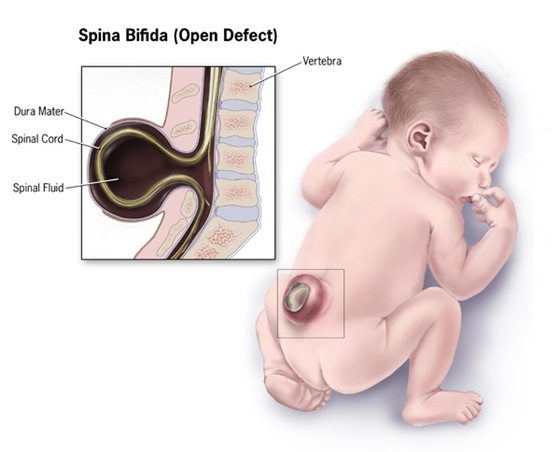 Spina Bifida (Open Defect)