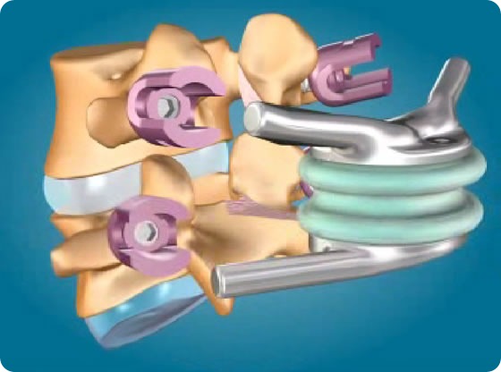 TOPS System, a Total Posterior Arthroplasty device