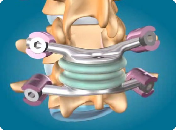 Sistema de las CAPOTAS, un dispositivo posterior total de la artroplastia