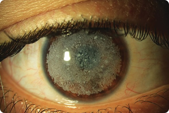 Granular Dystrophy eye