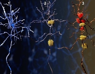 تحریک الکتریکی دو بار در روز باعث بهبود حافظه در بیماران آلزایمر می شود