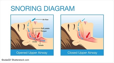 Types and Causes of Snoring