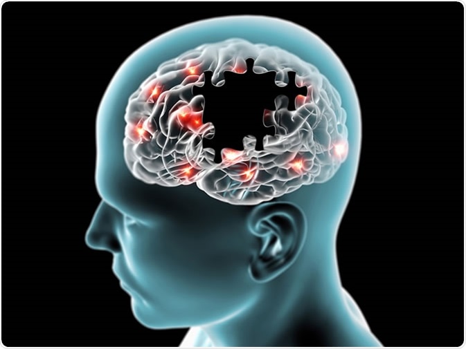 Neue Alzheimer-Medikament: Funktioniert es oder funktioniert es nicht?