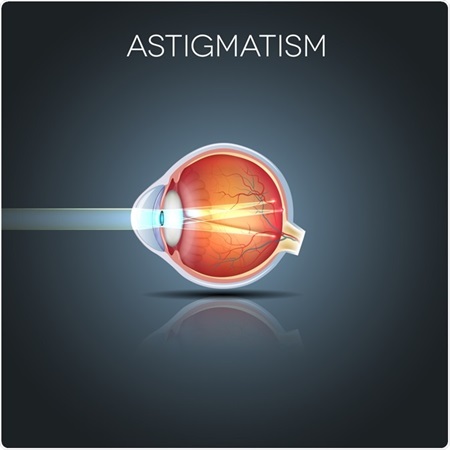Astigmatism Types - Regular and Irregular