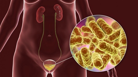 What is Chronic Cystitis?