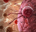 Immunotherapy extends survival in patients with advanced bladder cancer