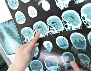 Research could provide more effective way to treat brain swelling after stroke