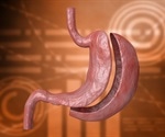 Gastric bypass more likely to require further treatment than gastric sleeve