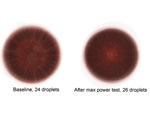 Patterns and cracks from dried blood droplets could indicate specific health conditions