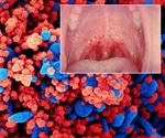 A new sign of COVID-19: a rash in the mouth