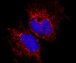 Research identifies protein molecule that could be responsible for aggressive breast cancers