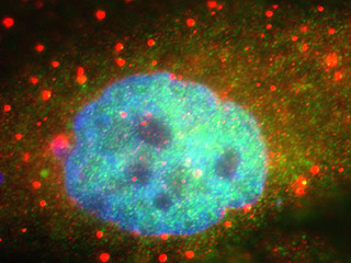This image shows P-bodies, in red, surrounding the nucleus of a human tumor cell. The red color indicates that the P-bodies contain the protein RCK. Photo credit: John Bloom.