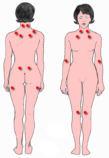The location of the nine paired tender points that comprise the 1990 American College of Rheumatology criteria for fibromyalgia.