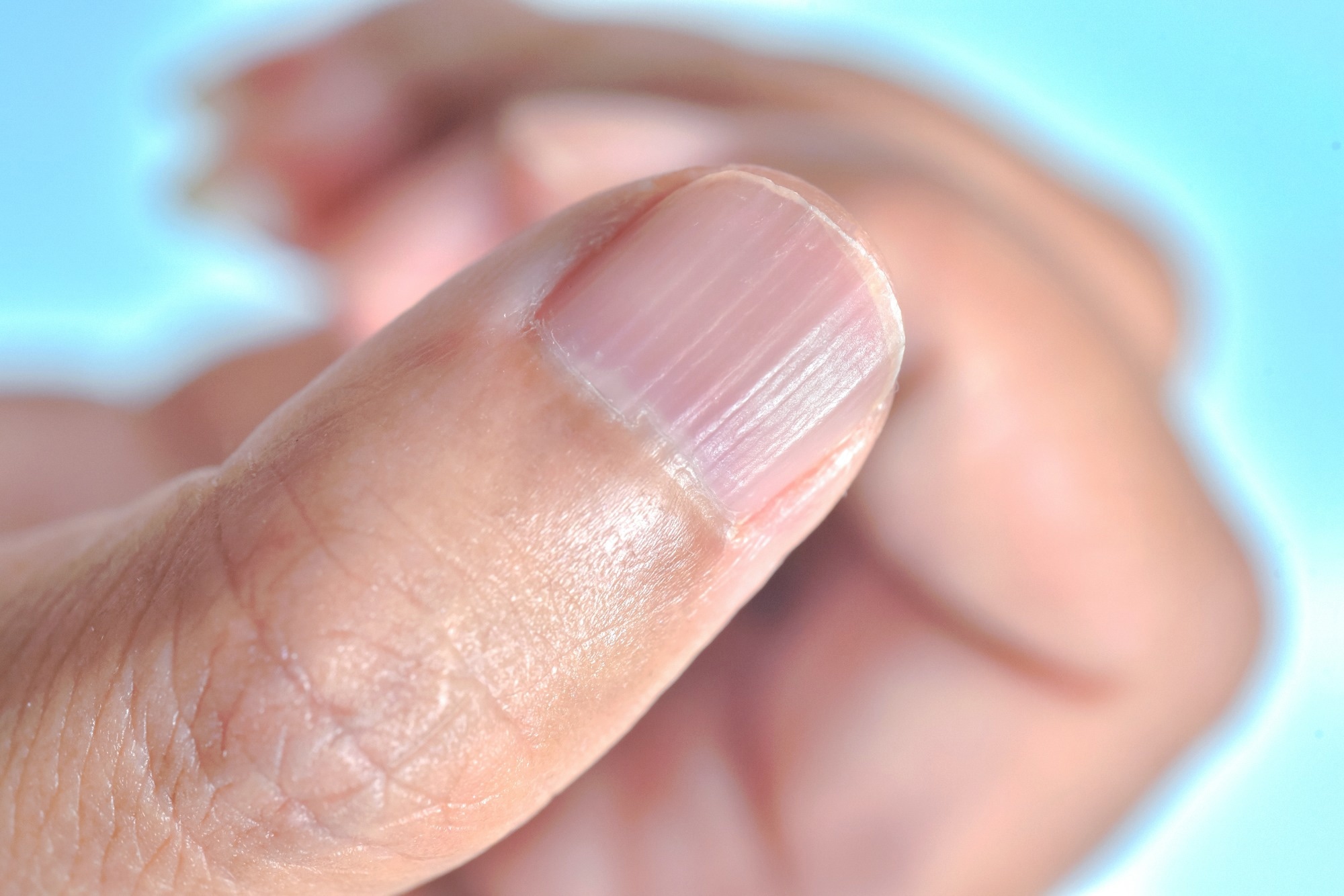 A toddler presents with a dark line on a fingernail | MDedge Pediatrics