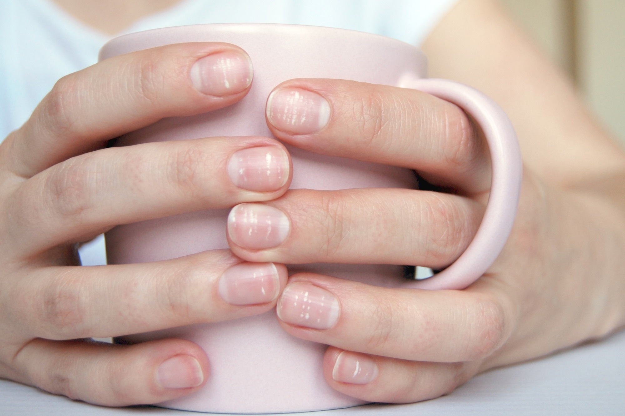 White spots on fingernails (Leukonychia). Image Credit: Nadya So / Shutterstock