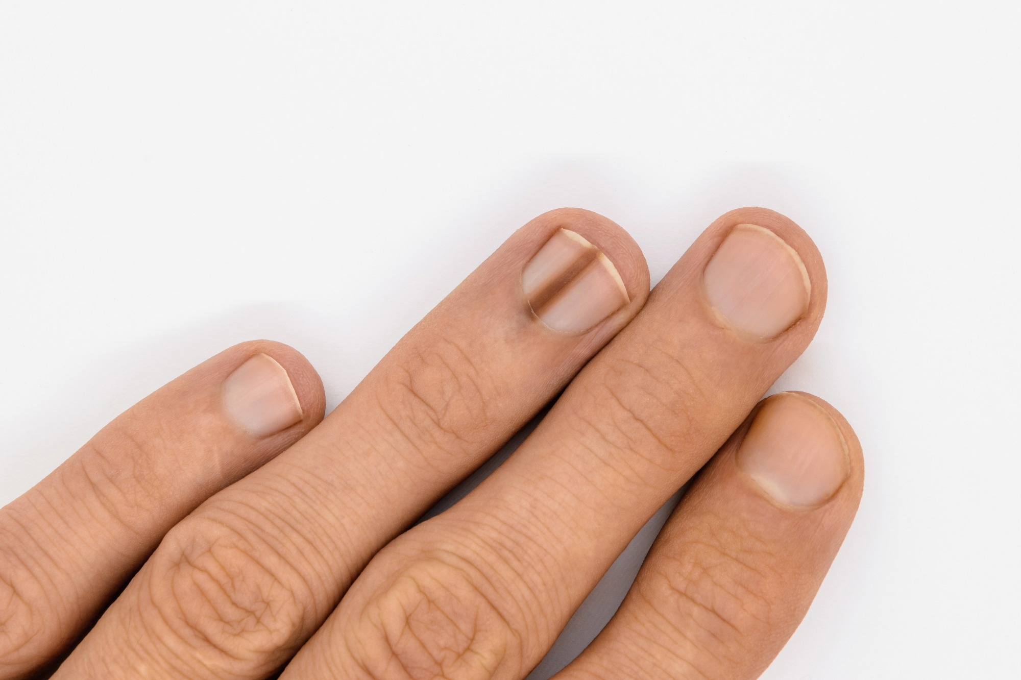 Male hand with brown line on one of the finger