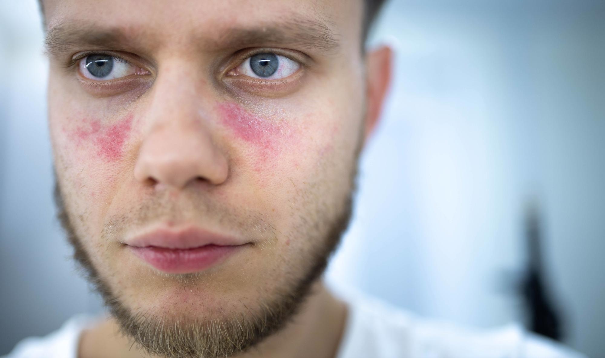 Age spots of redness on the face  from systemic lupus erythematosus. Image Credit: Velimir Zeland / Shutterstock