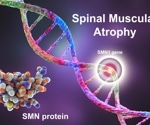 What are the Different Types of Spinal Muscular Atrophy?