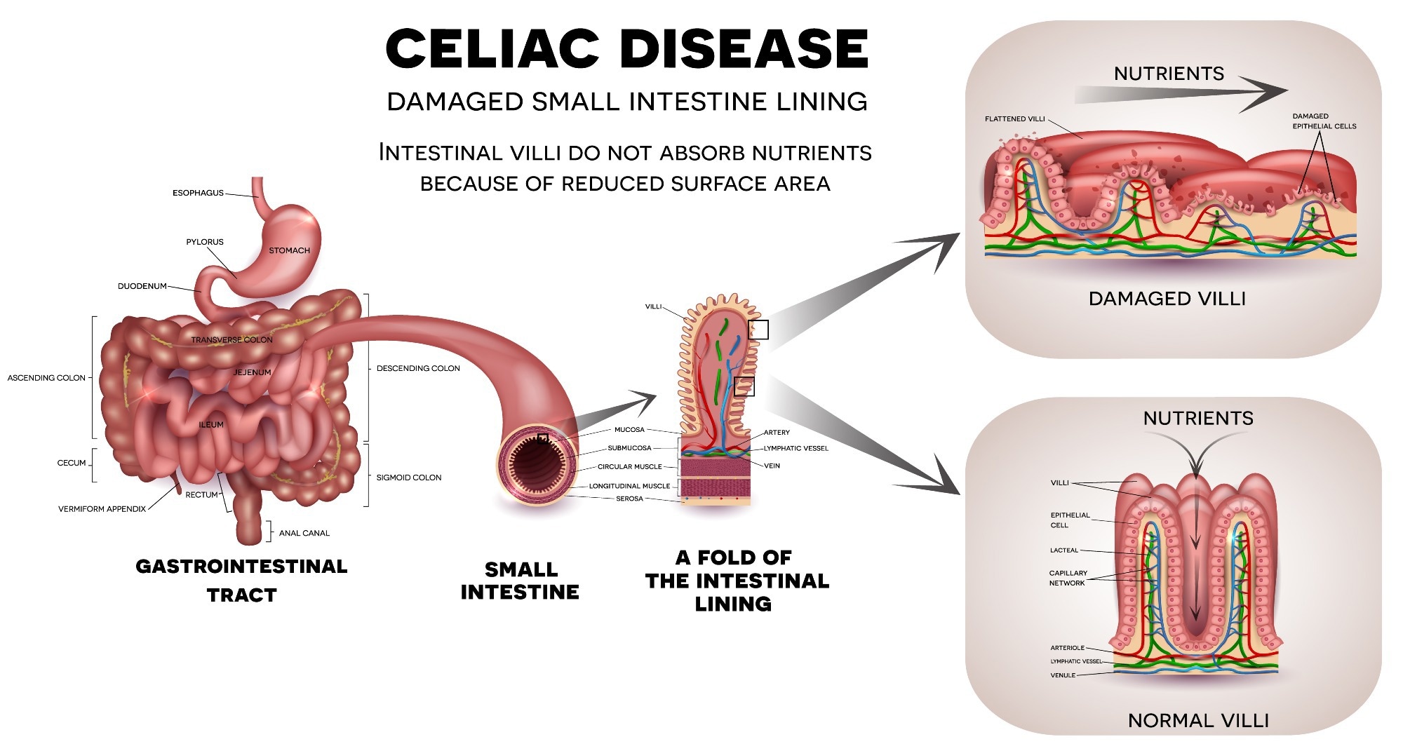 Celiac disease affected small intestine.Image Credit: Tefi / Shutterstock