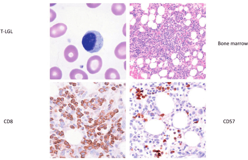 Monomorphic PTLD: T large granular lymphocytic leukemia. (A) Peripheral blood showing a large granular lymphocyte; (B) Bone marrow showing a vague lymphoid aggregate; (C) Bone marrow showing increased CD8 positive cells; (D) CD57 positive lymphocytes.