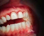 When Should You be Concerned about Bleeding Gums?
