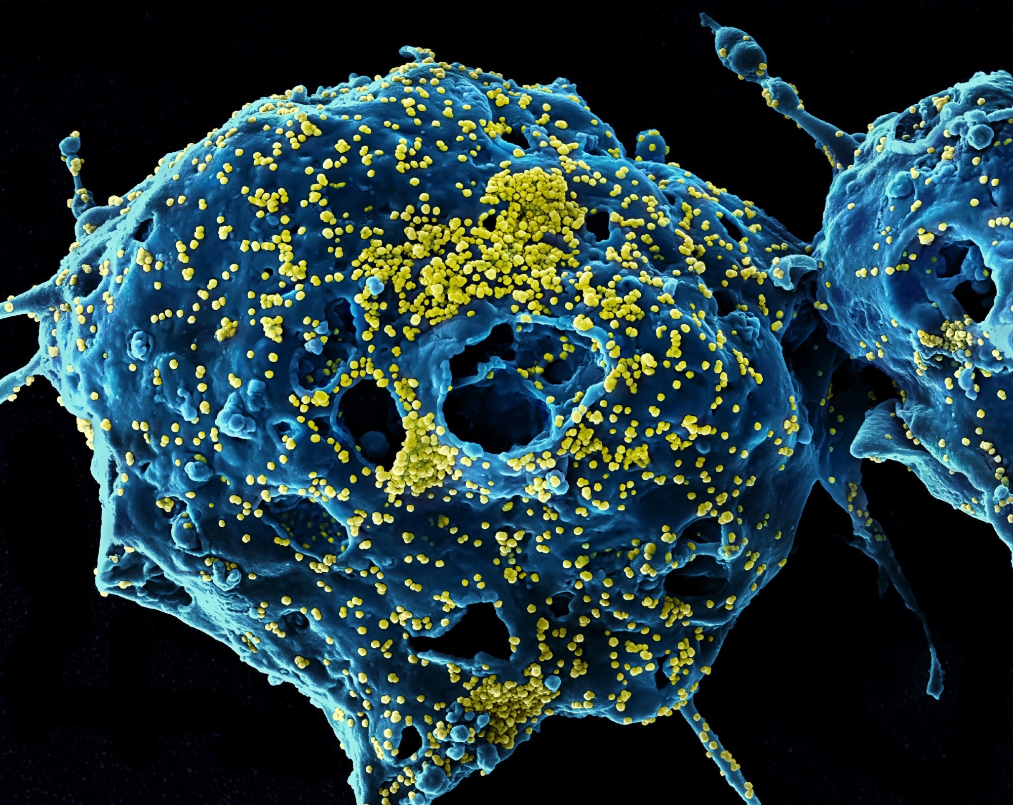 MERS Virus Particles Colorized scanning electron micrograph of Middle East Respiratory Syndrome virus particles (yellow) attached to the surface of an infected VERO E6 cell (blue). Image captured and color-enhanced at the NIAID Integrated Research Facility in Fort Detrick, Maryland. Credit: NIAID