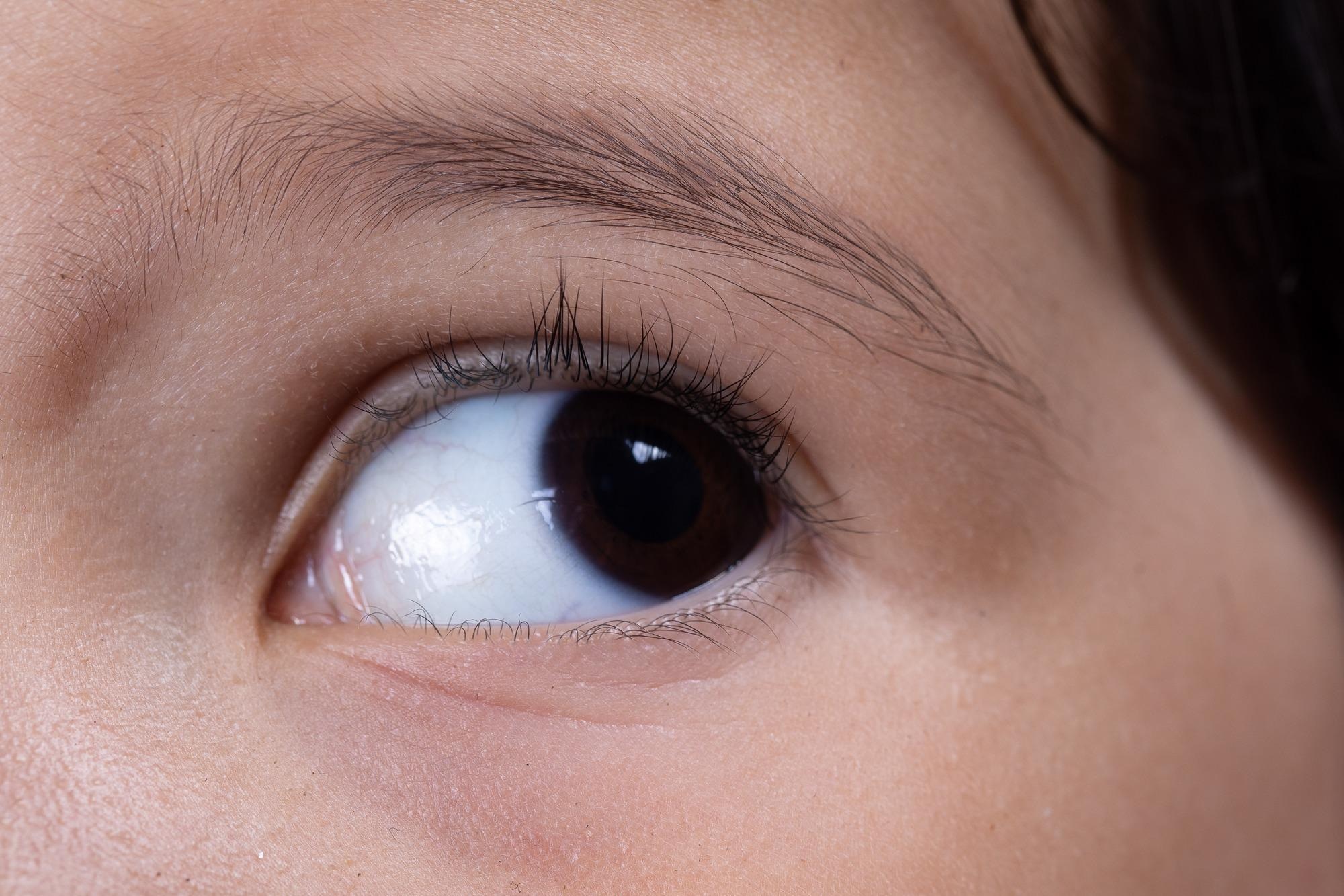 Aniridia - a rare genetic eye disorder that affects the iris. Image Credit: Sruilk / Shutterstock
