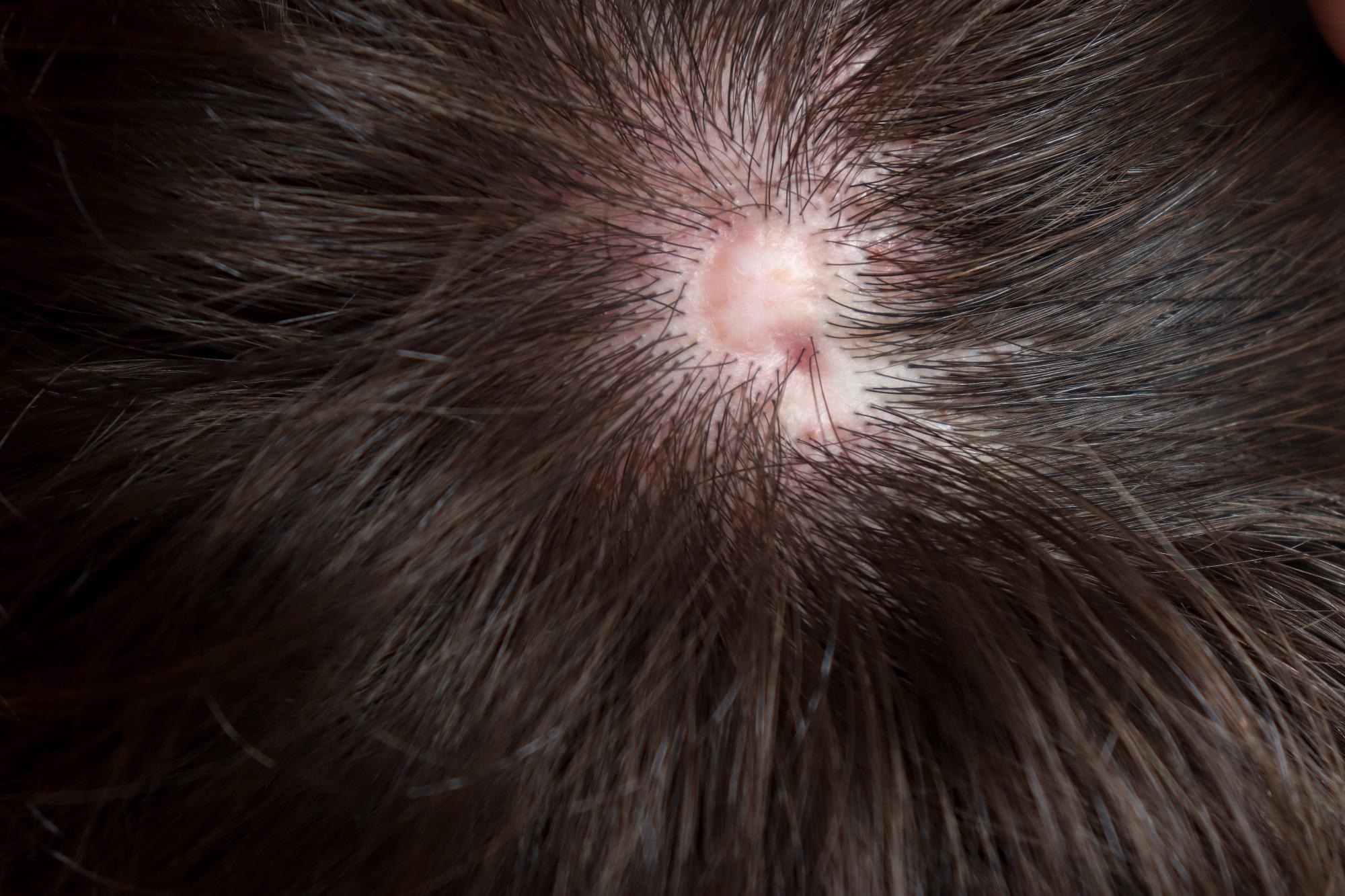​​​​​​​Nonsyndromic aplasia cutis congenita, a congenital defect with an absence of the epidermis, dermis and sometimes subcutaneous tissues. Usually on the top of the head. Image Credit: Kari Ahlers / Shutterstock