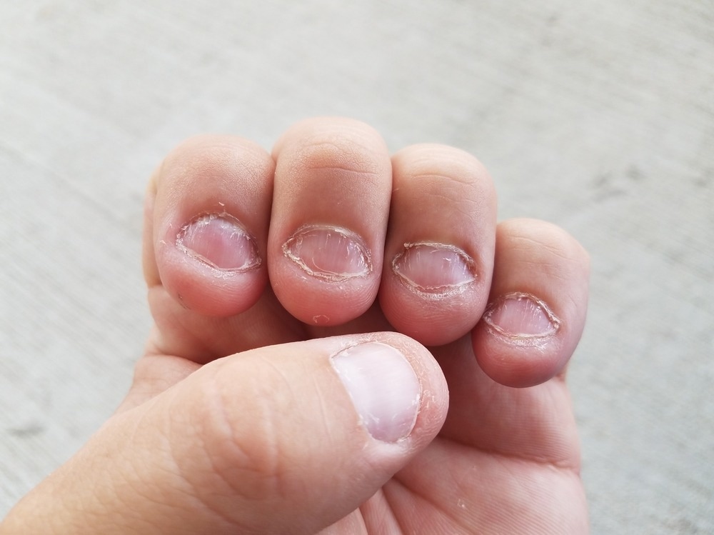 The Psychology Behind Nail Biting
