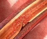 An Overview of Aortic Dissection