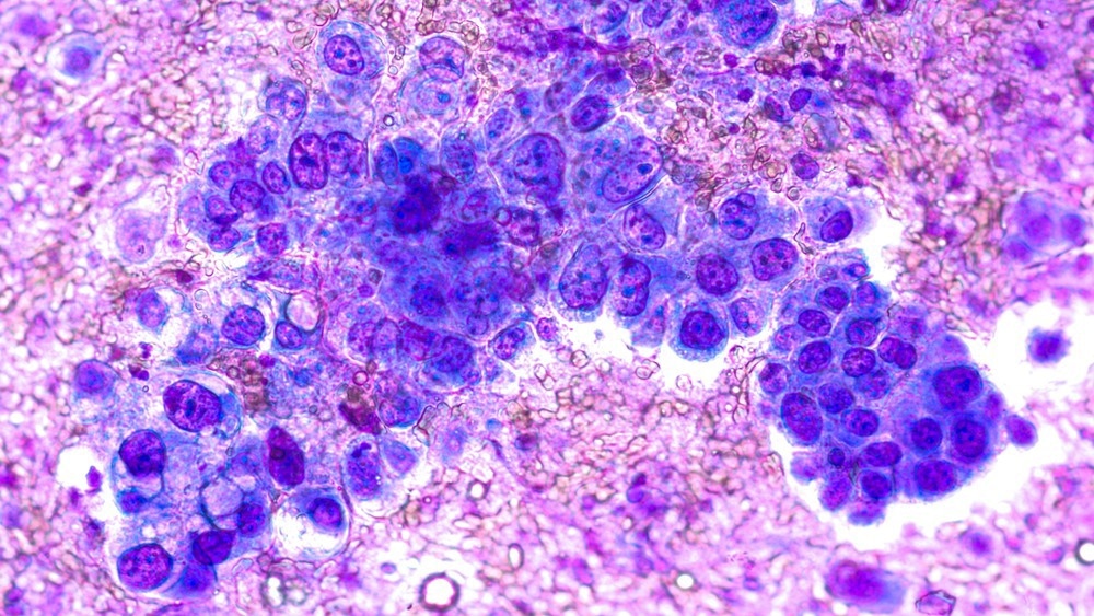 Non-small cell lung cancer