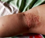 Bacterial Skin Infections: What are they?