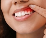 What are the Symptoms of Gingivitis?